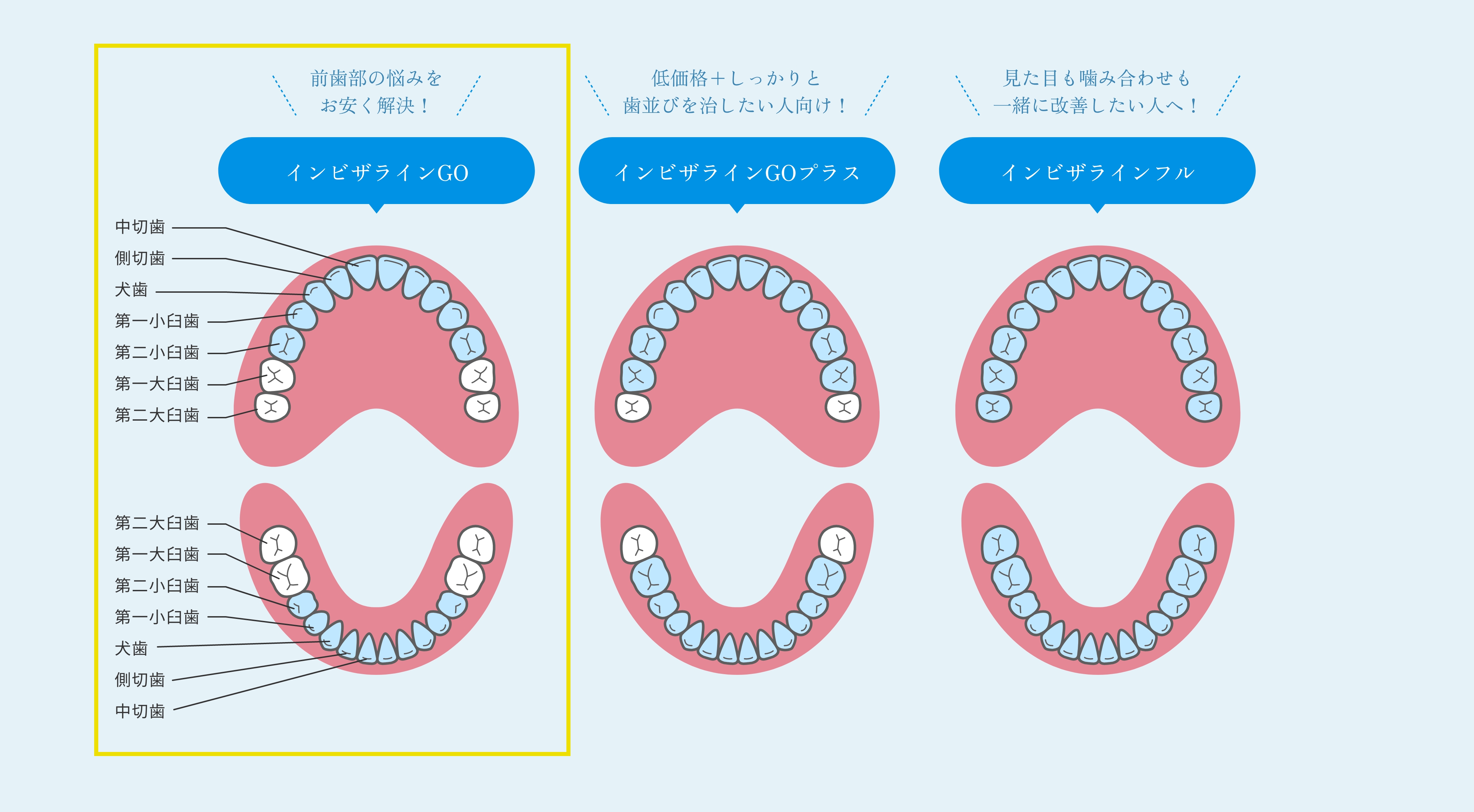 歯並び_インビザラインGO